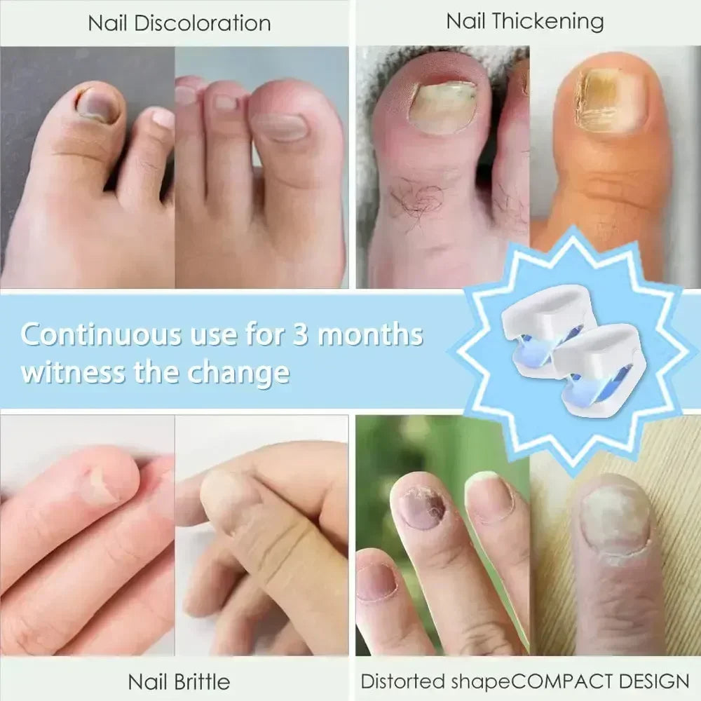 Nail Fungus Cleaning Laser Device - Expert Revolutionary High-Efficiency Light Therapy Device For Toenail Diseases