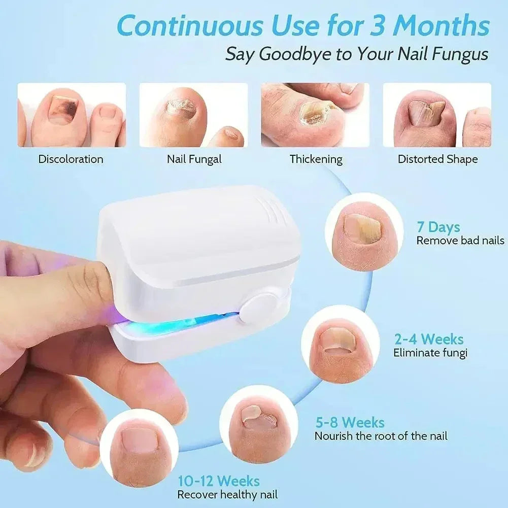 Nail Fungus Cleaning Laser Device - Expert Revolutionary High-Efficiency Light Therapy Device For Toenail Diseases