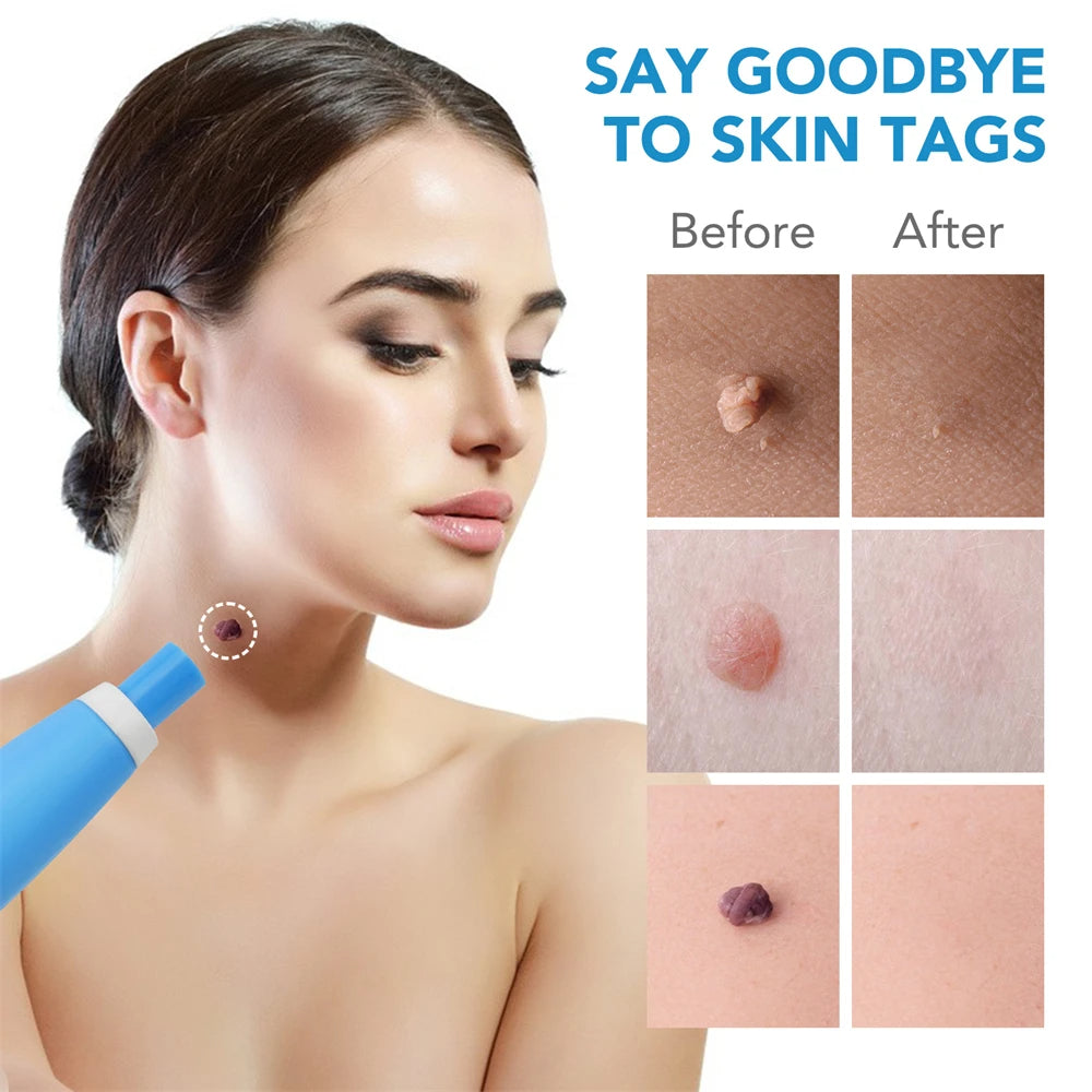 Éliminateur de grains de beauté indolore