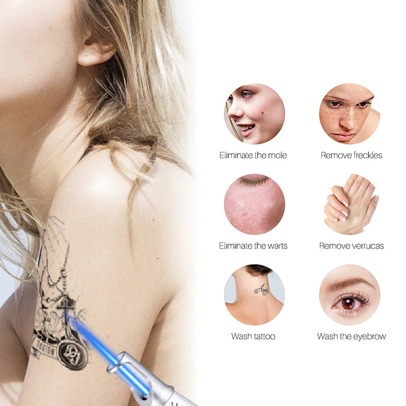 Stylo Laser Intelligent d’Élimination de Tatouage – Élimine les Grains de Beauté, Taches de Rousseur, Acné et Tatouages