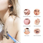 Stylo Laser Intelligent d’Élimination de Tatouage – Élimine les Grains de Beauté, Taches de Rousseur, Acné et Tatouages